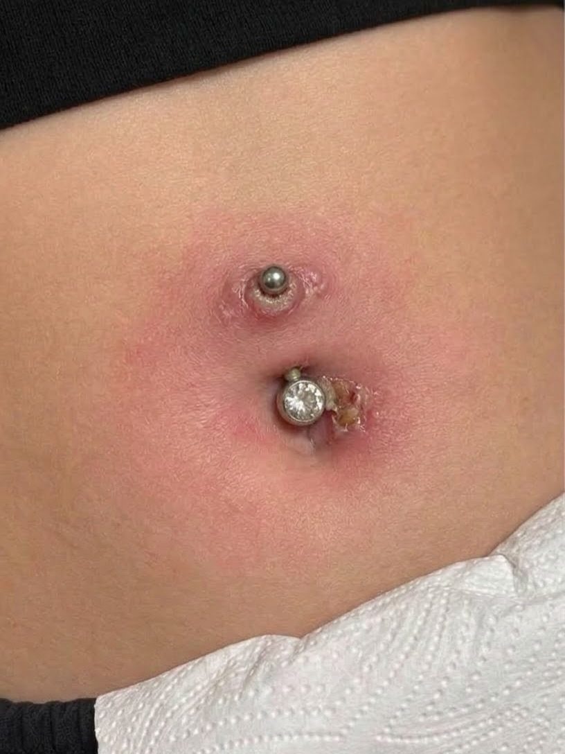 Irritated navel piercing with red, swollen skin and crusting around the jewelry.