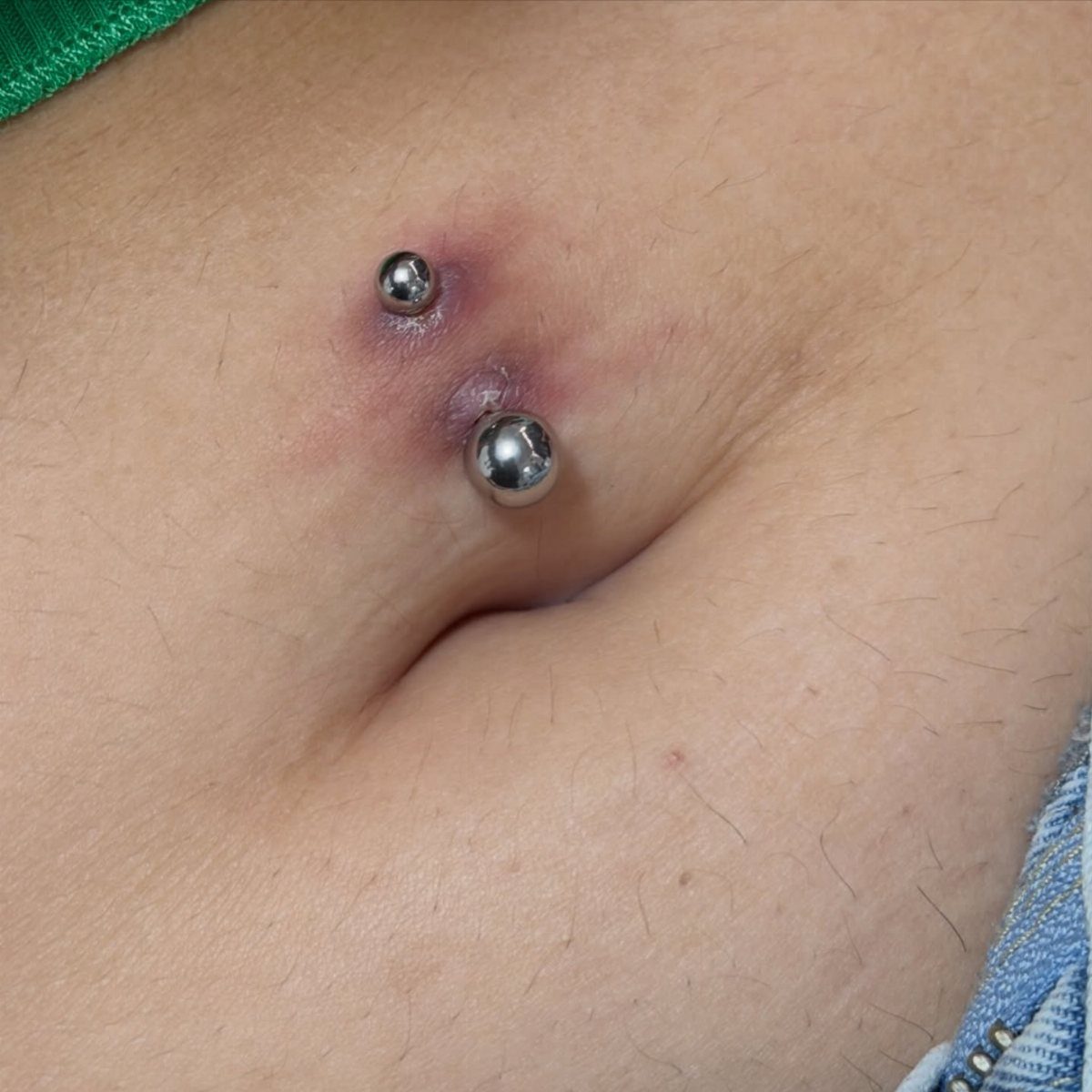 Red and swollen skin around a silver navel piercing on a stomach.