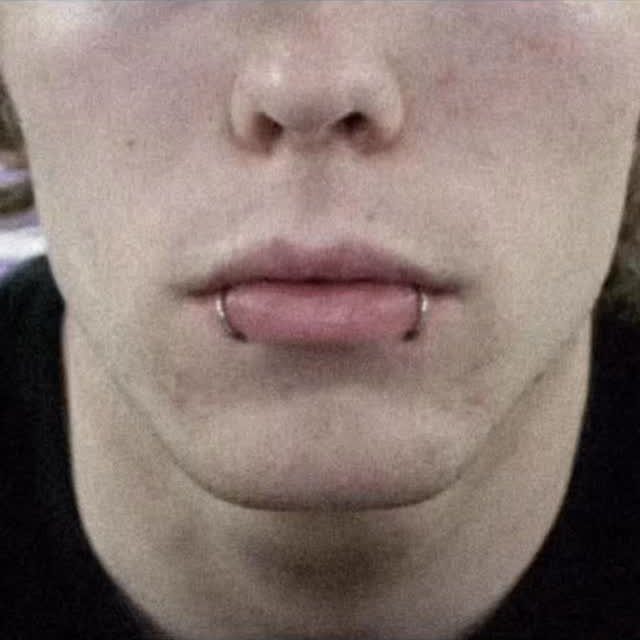Lower face of a person with silver hoop snake bites lip piercings.